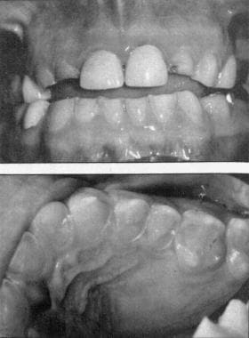 Dental caries. Reprinted with permission from Wolc