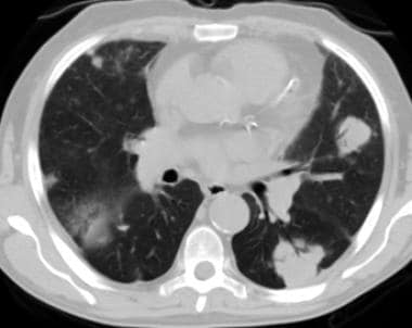 Contrast-enhanced chest CT scan showing poorly def