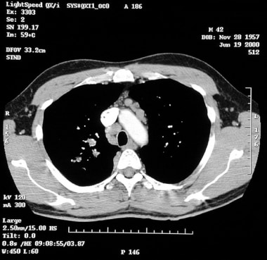 Restrictive lung disease may occur in stage II and