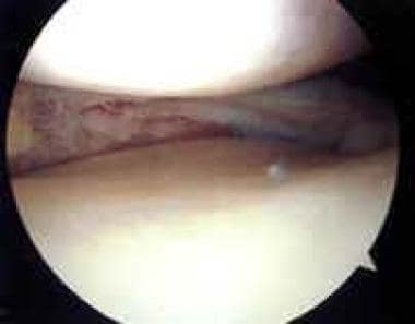 Arthroscopic view of medial meniscus after excisio
