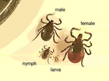 莱姆病。Magnified ticks at various stages of