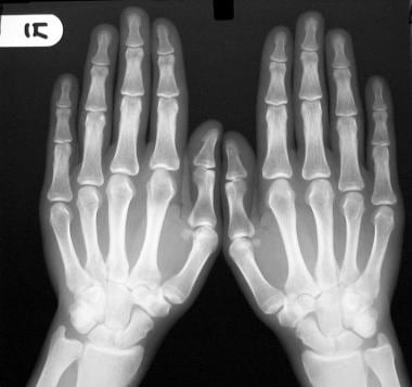 Radiograph of both hands shows small erosive chang