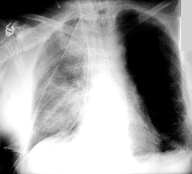 Seventy-two hours following lung transplantation, 