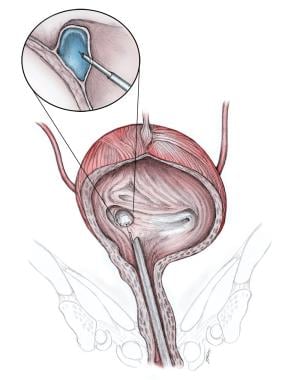 Vesicoureteral Reflux Treatment Management Approach Considerations Active Surveillance Medical Care