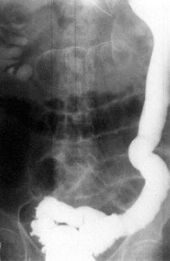 Contrast study demonstrates colonic obstruction at