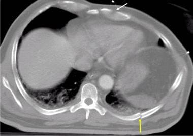 Axial computed tomography image of the chest in a 