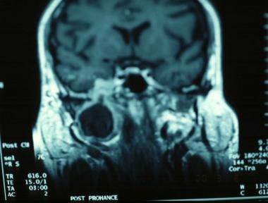 Coronal view MRI depicting a V3 neurilemoma. 