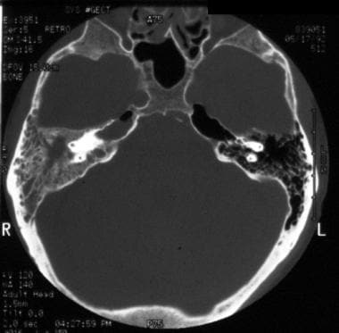Petrous apicitis. An axial CT scan of the temporal