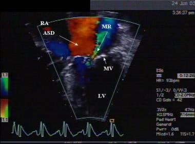 Apical color Doppler echocardiographic view of a p