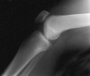 A normal lateral radiograph of a knee. In a normal