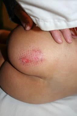 Pattern contact burn on buttocks of diapered child