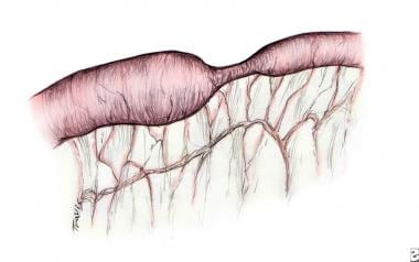 Small Intestinal Atresia and Stenosis: Practice Essentials,  Pathophysiology, Etiology