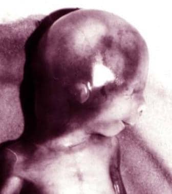 Lateral view of 19-week-old fetus with Treacher Co