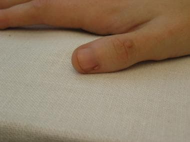 Periungual fibroma on the thumb of a patient with 