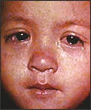 Measles conjunctivitis. 