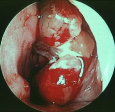 Rigid endoscopic view of the left nasal cavity, sh