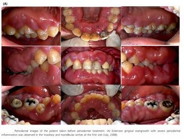 Periodontal images of the patient taken before per