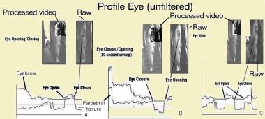 Video-to-scalar method applied to eye movement (pr
