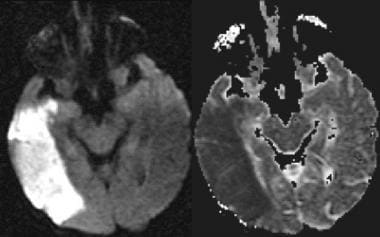 Magnetic resonance imaging. Large intracranial hemorrhage with moderate