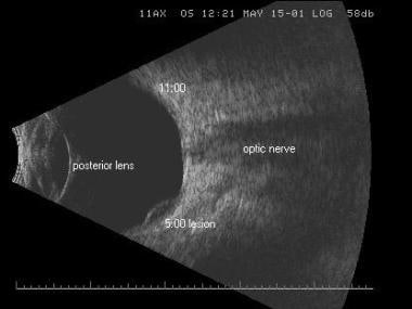 Axial scan of the same melanoma. The posterior len