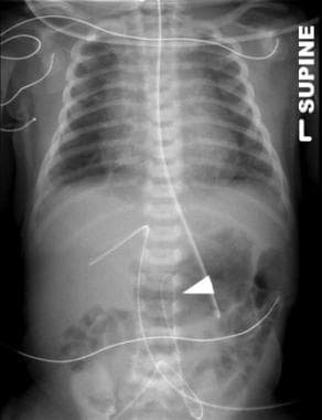 Umbilical Artery Catheterization: Overview, Indications, Contraindications