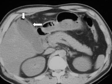 Emphysematous cholecystitis in a 47-year-old man w