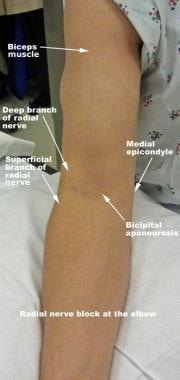 Radial nerve block at the elbow. The bicipital apo
