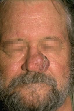 Case 6. Nodular basal cell carcinoma of the nose. 