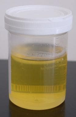 Urine sample. 