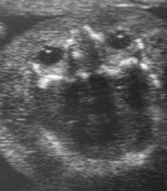 Fetal hydrops. Ultrasound image of edema of the sc