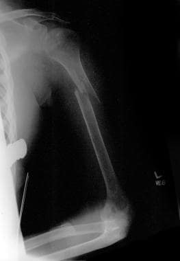 Fracture of an osteoporotic bone in a patient with