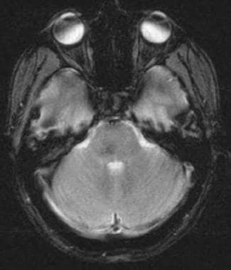 Axial fast low-angle shot MRI demonstrates decreas