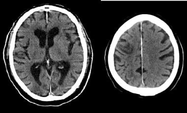 Noncontrast CT scan and MRI of the brain with DWI 