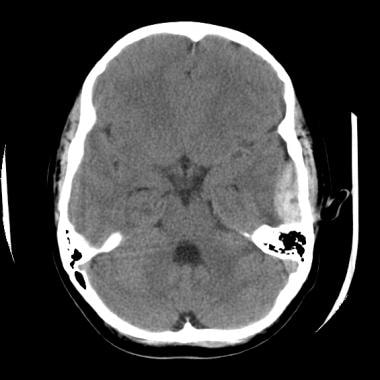 An epidural hematoma demonstrates the classic lent