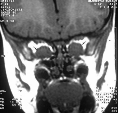 T1-weighted MRI in a 7-year-old girl with a family