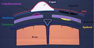 Diagram of the skull vault shows the location of v