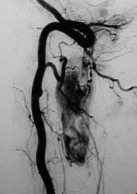 Spinal angiogram demonstrates a large cervical hem