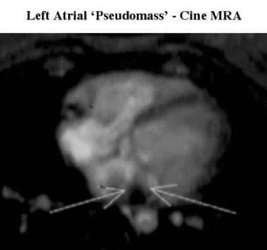 Axial cine magnetic resonance angiogram in a patie
