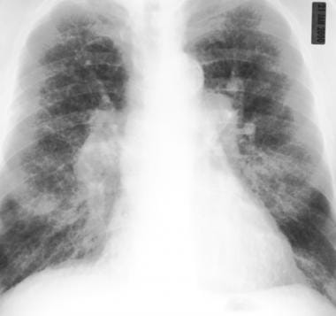Frontal chest radiograph in the same patient as in