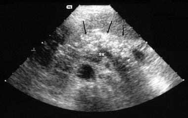 Chronic pancreatitis. Transverse sonogram shows an