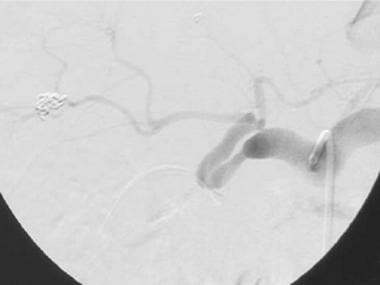 A-6: Digital subtraction angiogram shows a widely 