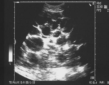 Sonogram of the liver in a patient with polycystic