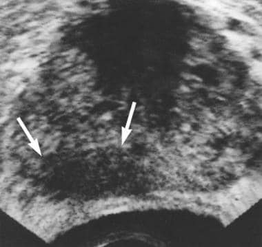 Axial transrectal ultrasonographic scan shows exte
