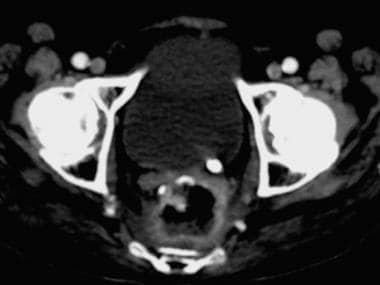 Contrast-enhanced CT showing calculus at left uret