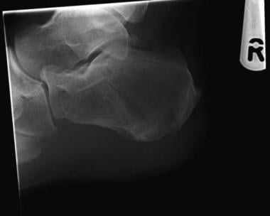 Calcaneus, fractures. Plain radiograph. 