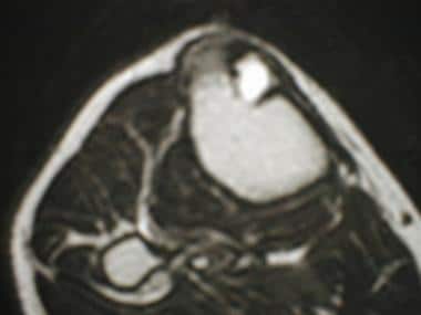 T2-weighted transverse MR image of the tibia of a 