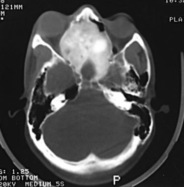 Axial bone-window CT scan shows a bony mass that e