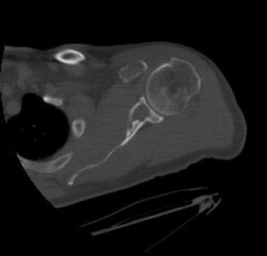 Axial computed tomography (CT) scan of the glenoid