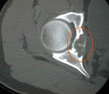 Axial computed tomography scan of the right hip in