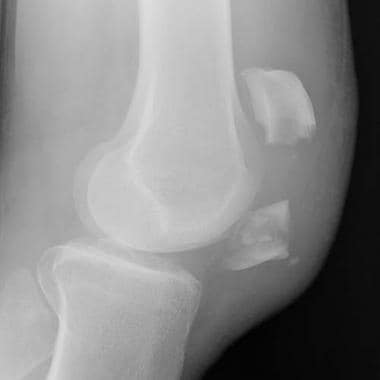 Radiograph of a displaced transverse fracture of t